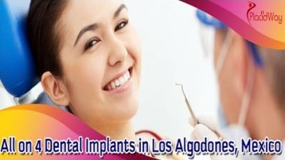 All-on-4 Dental Implants – Mouth Makeover in Los Algodones, Mexico