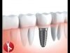 Are you a suitable candidate for dental implants?