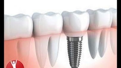 Are you a suitable candidate for dental implants?