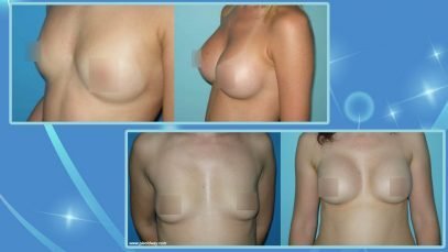 Before and After Breast Implants in Turkey