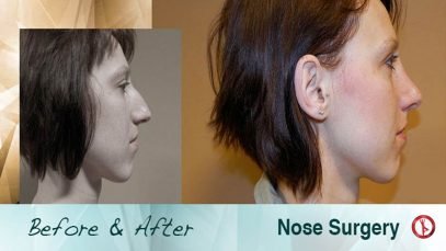 Before and After Nose Job Surgery in Czech Republic Europe