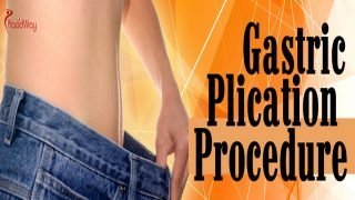 Gastric Plication Overview – Weight Loss Surgery Option