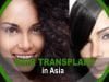 Hair Transplant Procedure in Asia