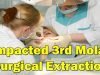 Impacted Lower 3rd Molar Surgical Extraction in Mexico