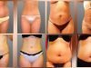 Liposuction Cosmetic Surgery Before and After in Mexicali Mexio