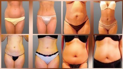 Liposuction Cosmetic Surgery Before and After in Mexicali Mexio