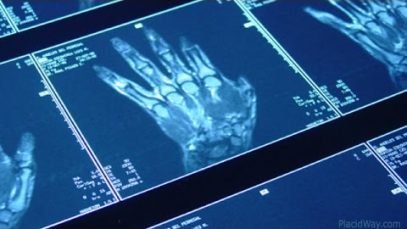 Orthopedic Hand Surgery Treatment Abroad