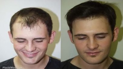 Plastic Surgery and Hair Transplant in Turkey