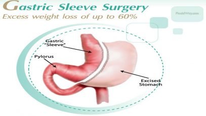 Top Gastric Sleeve in Mexico