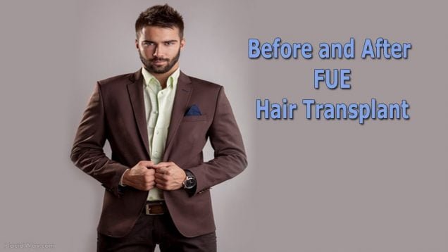 FUE Hair Transplant Surgery and Hair Restoration Cost in Turkey