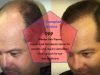 Hair Transplant Options in Istanbul, Turkey