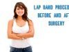 Lap Band Surgery Procedure – Safe WLS Abroad