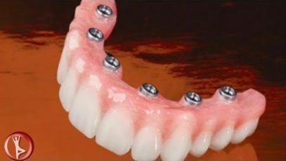 All On 6 Dental Implants Treatment Options In Tijuana Mexico