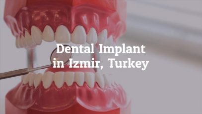 Get the Best Dental Implant Izmir, Turkey