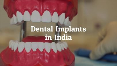 Why Go for Dental Implants in India