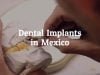 Get the Best Dental Implants in Mexico