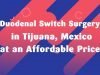Duodenal Switch Surgery in Tijuana, Mexico at an Affordable Price