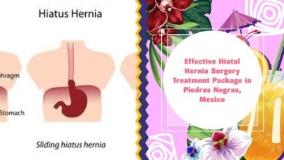 Effective Hiatal Hernia Surgery Treatment Package in Piedras Negras, Mexico