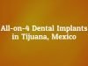 Guide To All On 4 Dental Implants in Tijuana, Mexico