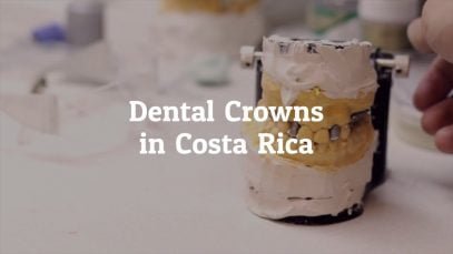 Important Facts About Dental Crowns in Costa Rica