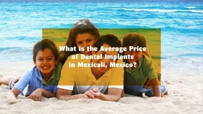 What is the Average Price of Dental Implants in Mexicali, Mexico?