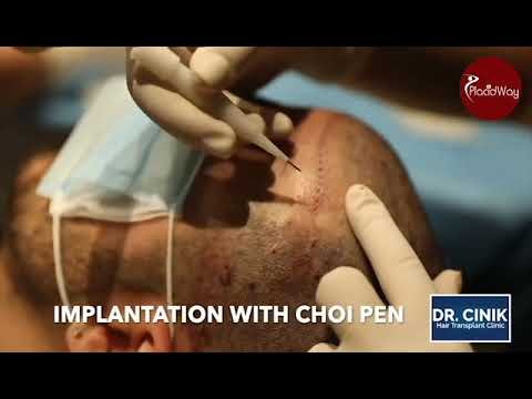 Hair Transplant with Choi Pen by Dr. Emrak Cinik at Istanbul, Turkey