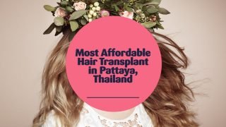 Most Affordable Hair Transplant in Pattaya, Thailand