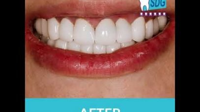 Amazing Before and After Results at Sani Dental Group, Los Algodones, Mexico