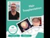 Happy Patient after Successful Hair Transplant at Saluss Medical Group, Antalya, Turkey