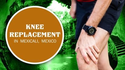 Suitable Package for Knee Replacement in Mexicali, Mexico