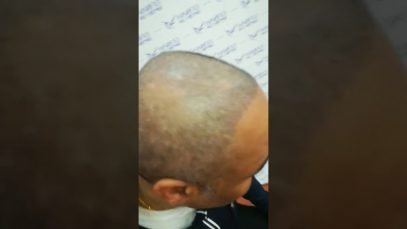 Feel Great after Hair Transplant in Hanfei Plastic Surgery, Guangzhou, China