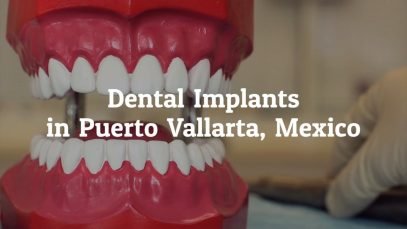 Popular Dental Implants Procedure at Puerto Vallarta, Mexico