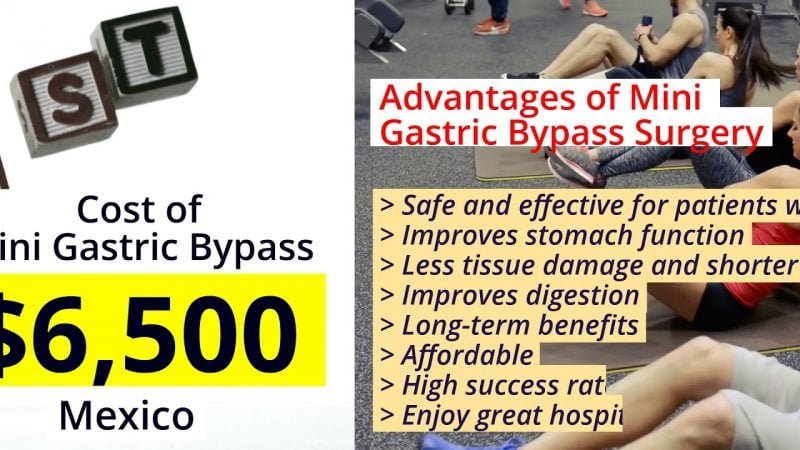 Affordable Roux-En-Y Gastric Bypass Package in Merida, Mexico