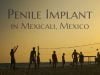 Advanced Penile Implant in Mexicali, Mexico