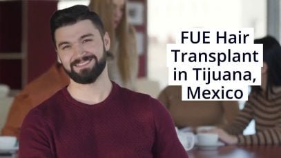 Expert Cosmetologists bring Top-Notch FUE Hair Transplant in Tijuana, Mexico