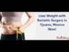 Weight Lose with Bariatric Surgery in Tijuana, Mexico