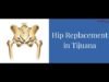 Hip Replacement Surgery in Tijuana Mexico