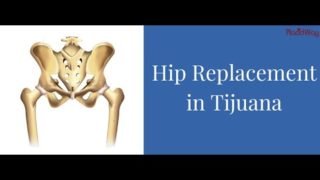 Hip Replacement Surgery in Tijuana Mexico